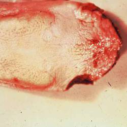 Ulcer on tongue due to bot larva. 